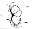 Fig. 21 - Intravascular medical device