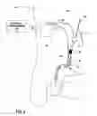 Fig. 03 - Electrical stimulation to alleviate chronic pelvic pain