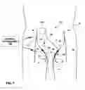 Fig. 08 - Electrical stimulation to alleviate chronic pelvic pain