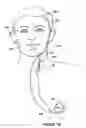 Fig. 07 - Multipolar stimulation electrode with mating structures for gripping targeted tissue
