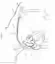 Fig. 20 - Intravascular medical device