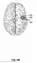 Fig. 04 - Electrode geometries for efficient neural stimulation