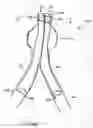 Fig. 02 - Stent graft including expandable cuff
