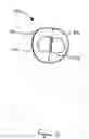 Fig. 12 - Stent graft including expandable cuff