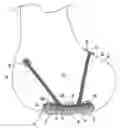 Fig. 01 - Cartilage resurfacing implant