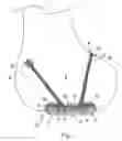 Fig. 02 - Cartilage resurfacing implant