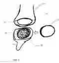 Fig. 05 - SYSTEM AND METHOD FOR ARTICULAR SURFACE REPAIR