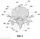 Fig. 04 - Passive lubricating prosthetic joint