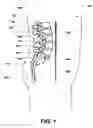 Fig. 02 - Intervertebral prosthetic disc and method of installing same