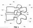 Fig. 03 - Intervertebral prosthetic disc and method of installing same
