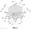 Fig. 04 - Intervertebral prosthetic disc and method of installing same