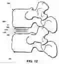 Fig. 10 - Intervertebral prosthetic disc and method of installing same