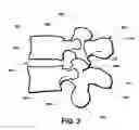 Fig. 03 - Intervertebral prosthetic disc