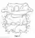Fig. 04 - Method for resurfacing a cervical articular facet