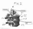 Fig. 02 - Method and composition for repair and reconstruction of intervertebral discs and other reconstructive surgery