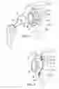 Fig. 04 - Method and apparatus for performing a shoulder implant procedure