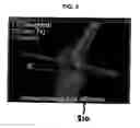 Fig. 06 - Functional joint arthroplasty method