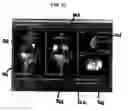 Fig. 11 - Functional joint arthroplasty method