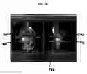 Fig. 13 - Functional joint arthroplasty method