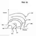 Fig. 20 - Functional joint arthroplasty method