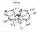 Fig. 22 - Functional joint arthroplasty method