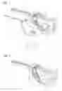 Fig. 02 - Method for molding a sound canal of a hearing device