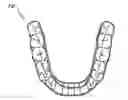 Fig. 01 - Orthodontic appliance with embedded wire for moving teeth