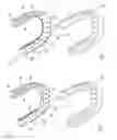 Fig. 02 - Orthodontic appliance with embedded wire for moving teeth