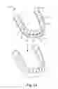 Fig. 03 - Orthodontic appliance with embedded wire for moving teeth