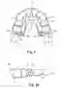 Fig. 06 - Orthodontic appliance with embedded wire for moving teeth