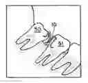 Fig. 01 - Orthodontic spring for treatment of an impacted molar