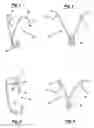 Fig. 02 - Orthodontic spring for treatment of an impacted molar