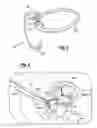 Fig. 03 - Orthodontic spring for treatment of an impacted molar