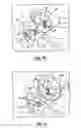 Fig. 06 - Orthodontic spring for treatment of an impacted molar