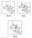 Fig. 07 - Orthodontic spring for treatment of an impacted molar