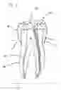 Fig. 02 - Precision cast dental instrument