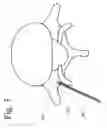 Fig. 04 - Treatment of pain, neurological dysfunction and neoplasms using radiation delivery catheters