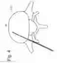 Fig. 05 - Treatment of pain, neurological dysfunction and neoplasms using radiation delivery catheters