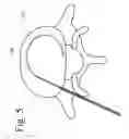 Fig. 06 - Treatment of pain, neurological dysfunction and neoplasms using radiation delivery catheters