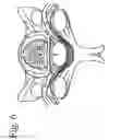 Fig. 07 - Treatment of pain, neurological dysfunction and neoplasms using radiation delivery catheters