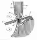 Fig. 01 - Magnetic device and method to prevent gastroesophageal reflux, fecal incontinence and urinary incontinence