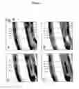 Fig. 04 - Magnetic device and method to prevent gastroesophageal reflux, fecal incontinence and urinary incontinence
