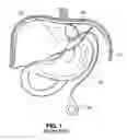 Fig. 02 - Two-way adjustable implant