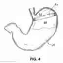 Fig. 04 - Two-way adjustable implant