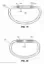 Fig. 12 - Two-way adjustable implant
