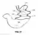 Fig. 13 - Two-way adjustable implant