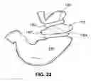 Fig. 14 - Two-way adjustable implant