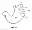 Fig. 15 - Two-way adjustable implant
