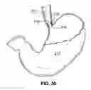 Fig. 20 - Two-way adjustable implant