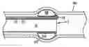 Fig. 01 - Vascular clip-on occlusion system